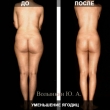 Почему Ручная Пластика® лучше липоскации?