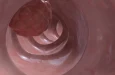Исследование Института Гарвана: скрытое воспаление может объяснять повышенный риск рака толстой кишки при ПСХ