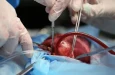 Простое прикроватное сканирование бедра может предсказать риск легочных осложнений после операций на сердце