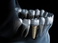 Зубные имплантаты использовались Майя