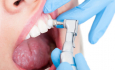 Как выполняется лечение зубов?